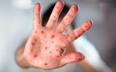 Aumentan contagios de sarampión en América, en Colombia se confirman tres casos