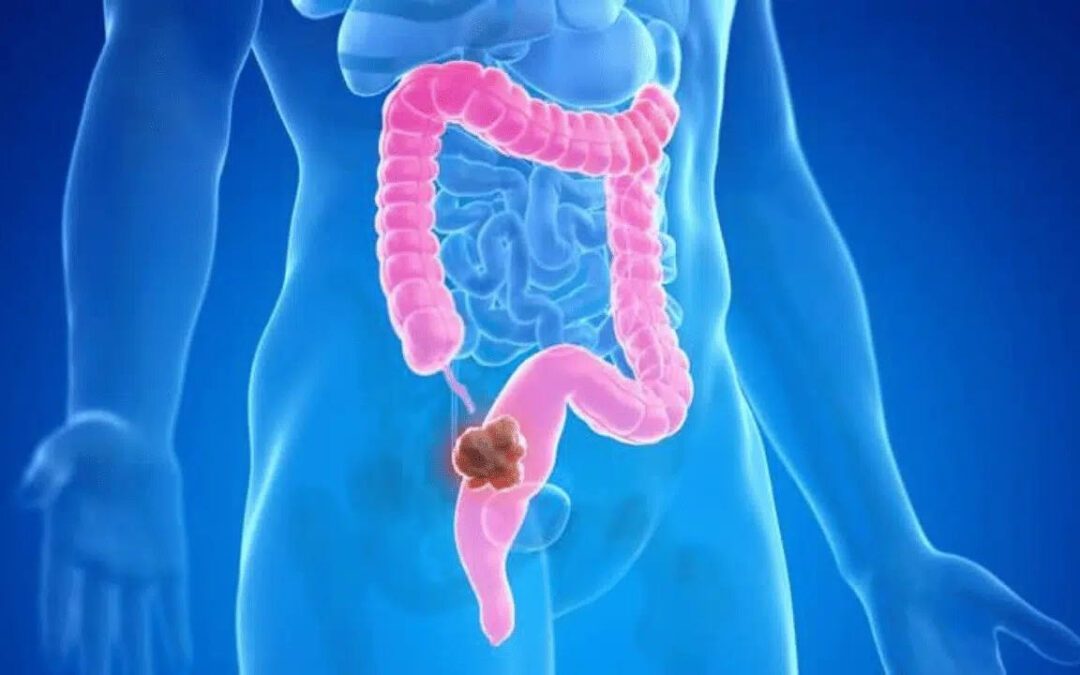 Cuando el cáncer colorrectal se detecta en etapas iniciales, las tasas de curación pueden superar el 90 %