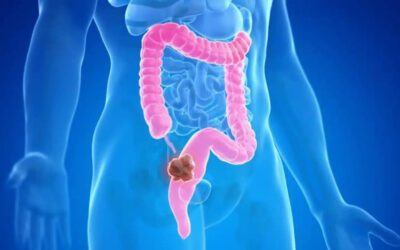 Cuando el cáncer colorrectal se detecta en etapas iniciales, las tasas de curación pueden superar el 90 %