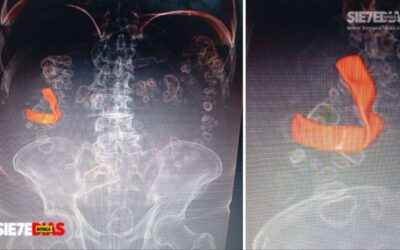 Usuario de Nueva EPS denuncia cuerpo extraño tras cirugía en la Clínica El Laguito, en Sogamoso