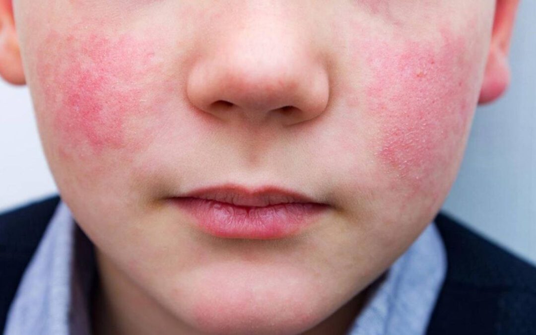 Cuarentena en colegio de Paz de Río por brote de parvovirus en estudiantes de primero