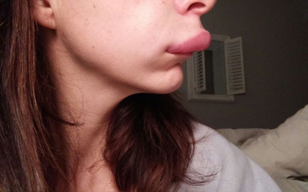Angioedema hereditario: la enfermedad rara que afecta a cientos de familias y tiene alta presencia en Boyacá
